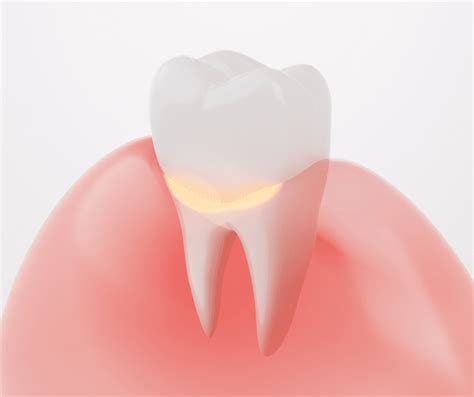 gum disease treatment bradenton fl|Gingivitis Treatment .